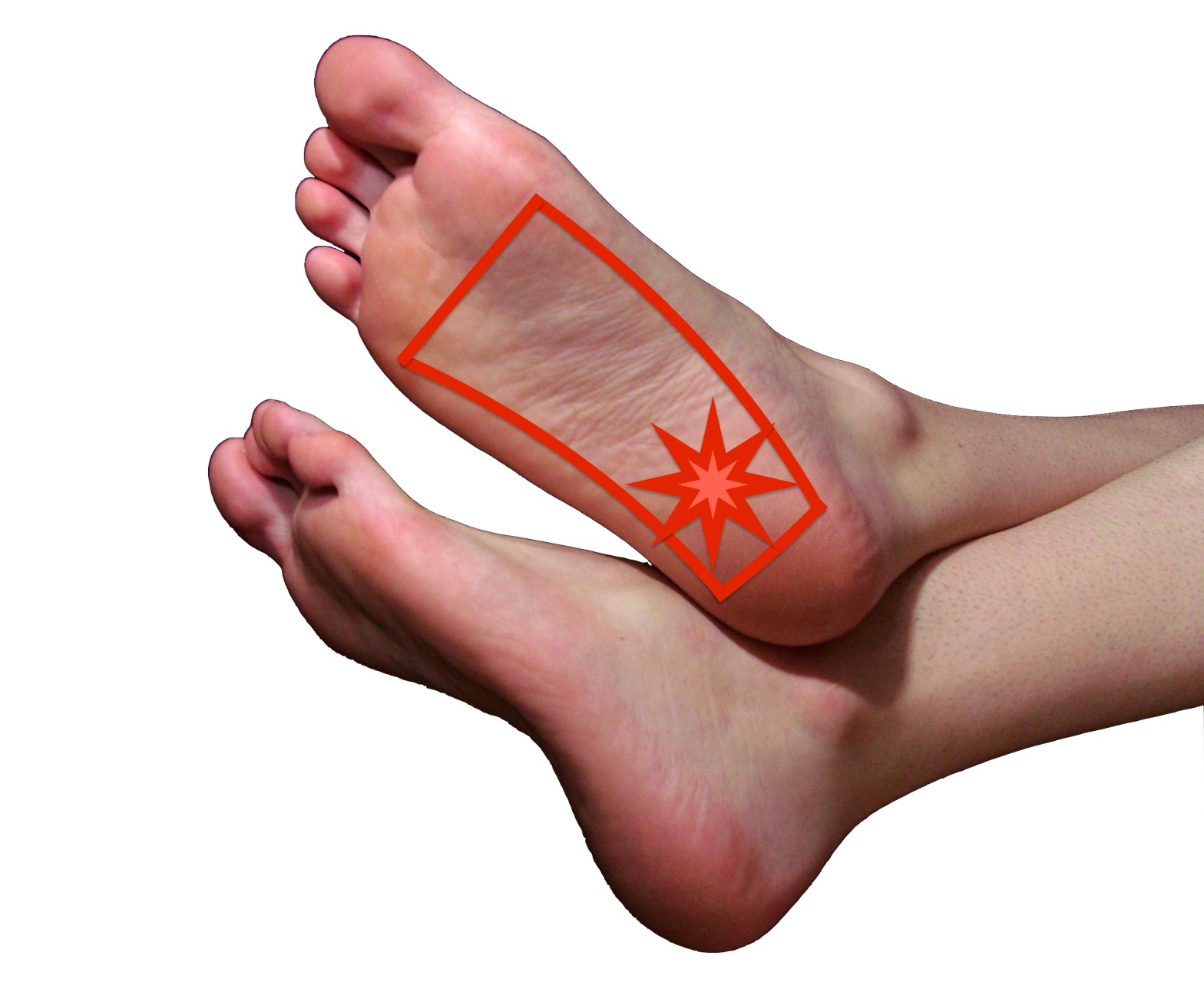 heel pain plantar fasciitis