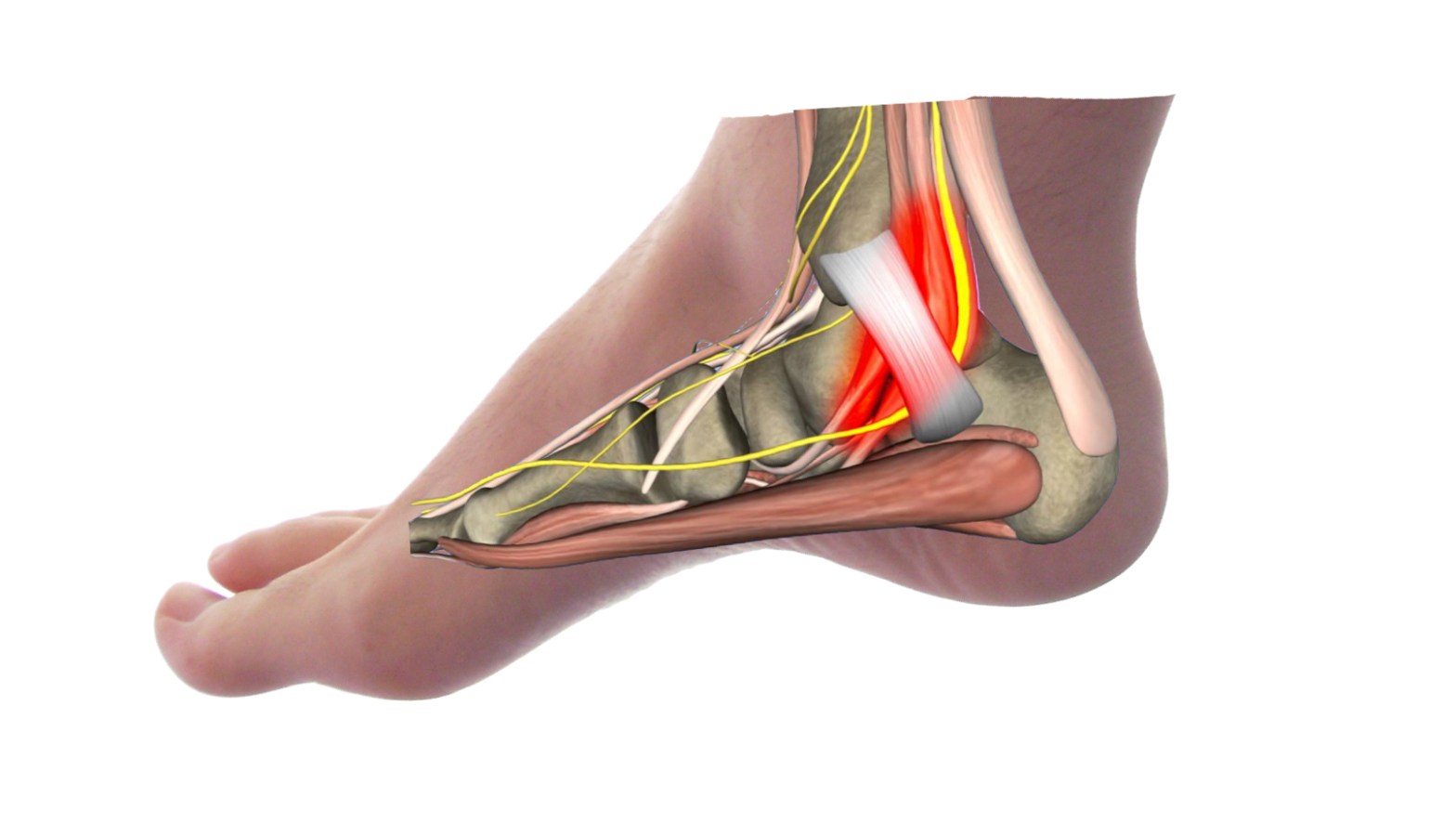 tarsal tunnel syndrome