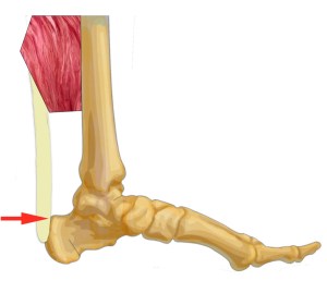 Achilles tendonitis