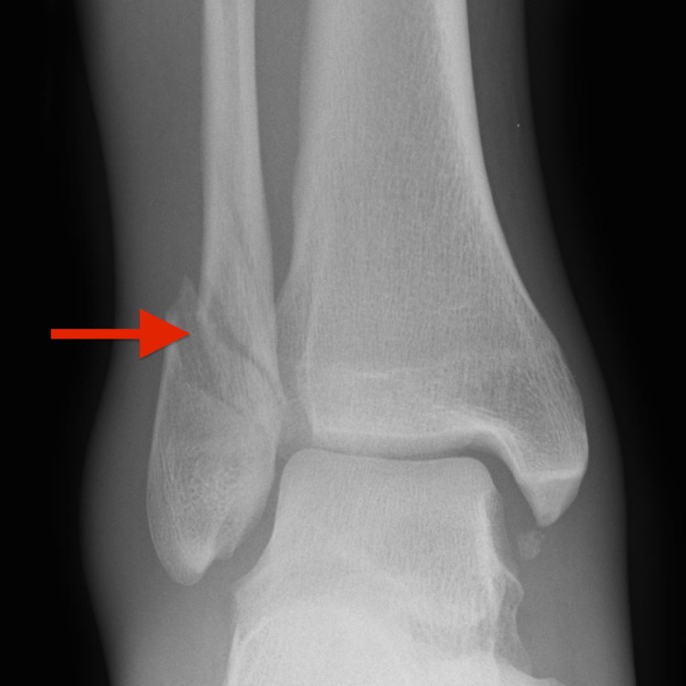 ankle fracture