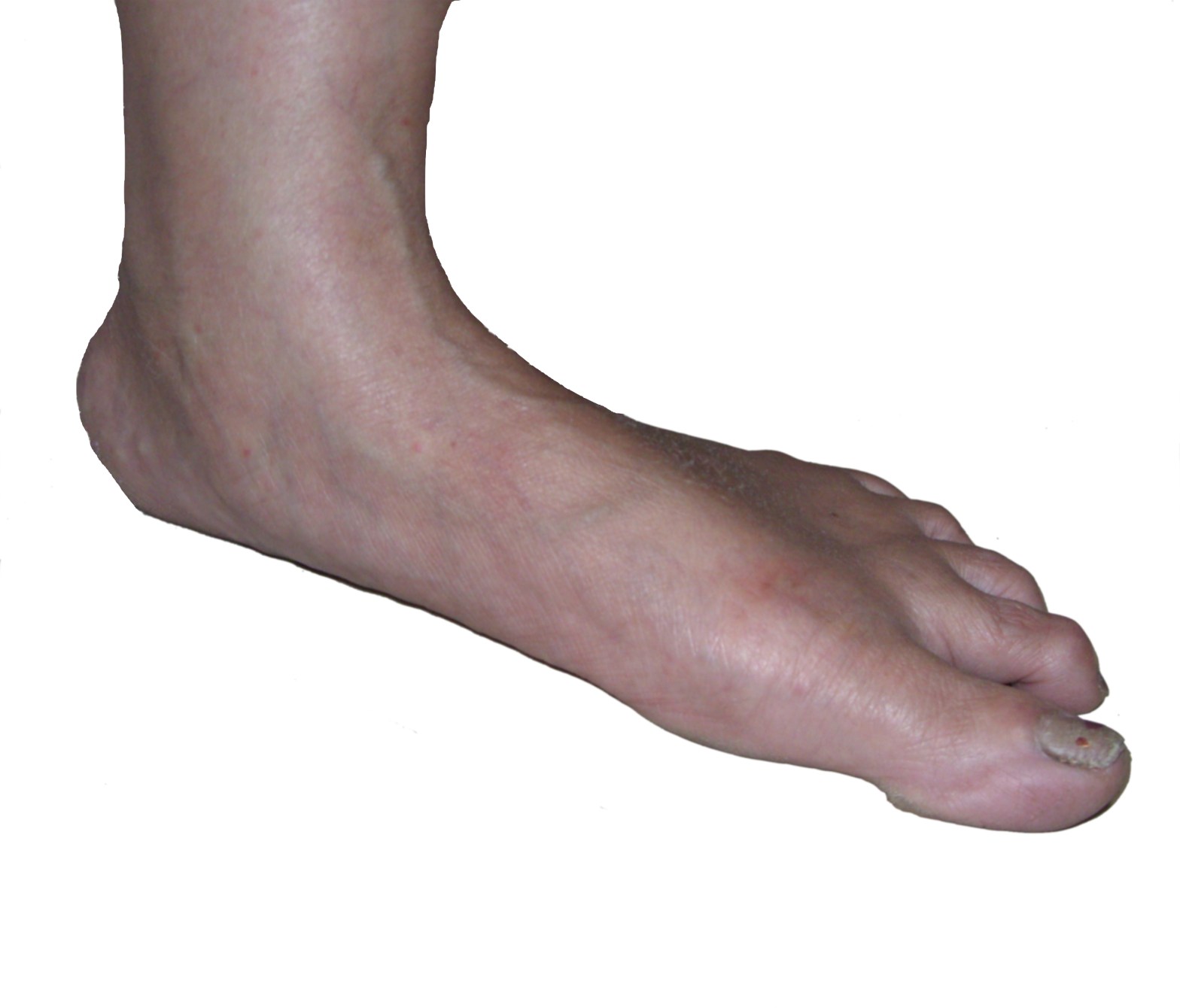 flat foot