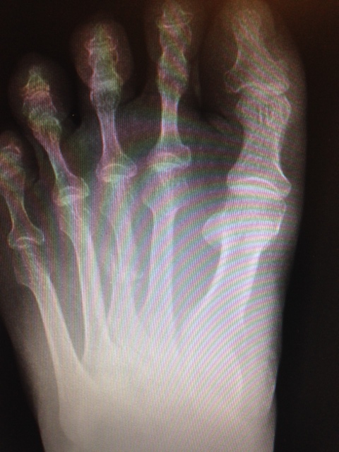 metatarsal fracture