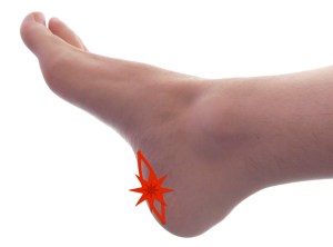 plantar fasciitis