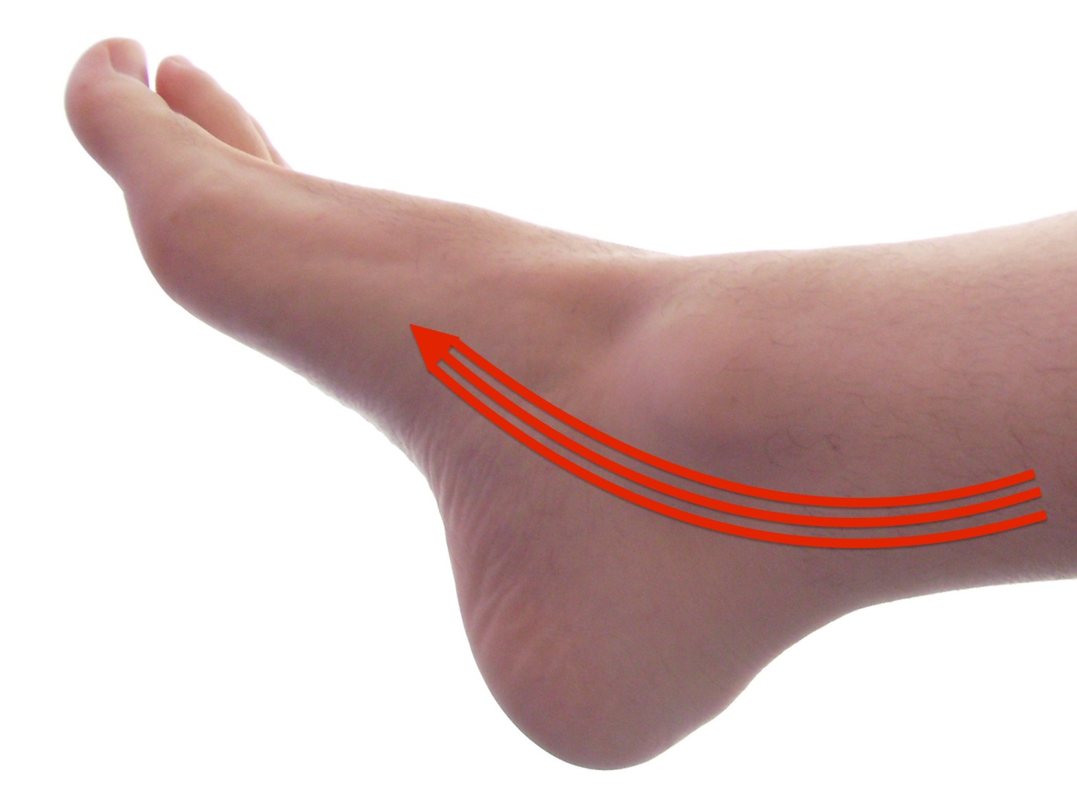 posterior tibial tendonitis