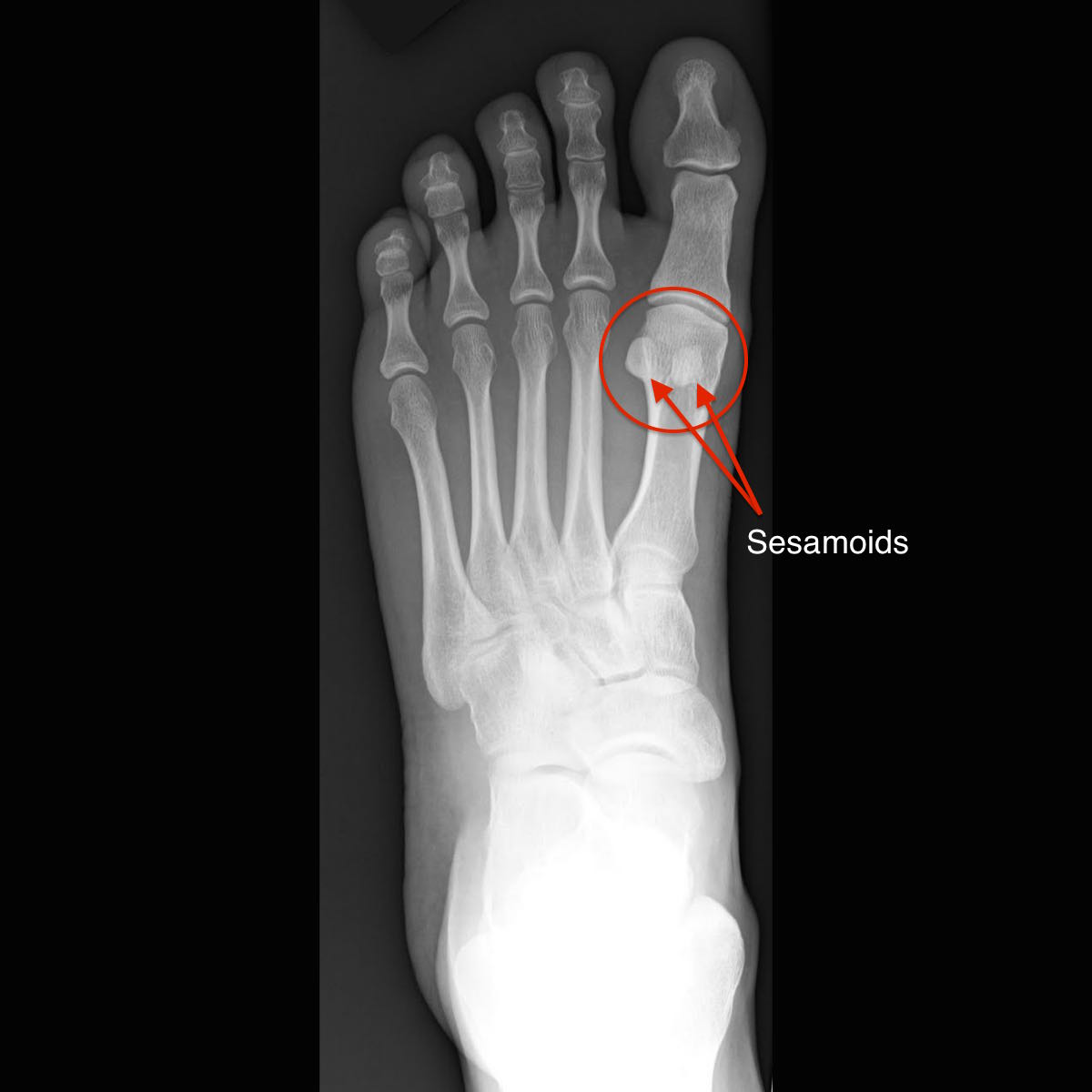 sesamoid bones in foot