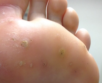 foot warts
