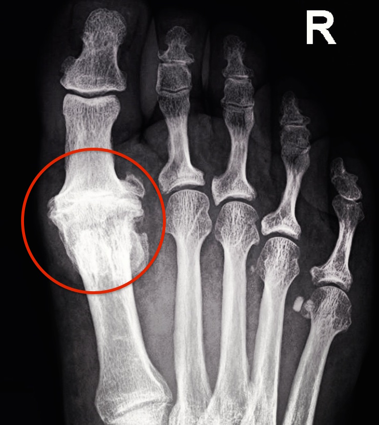 great toe joint arthritis