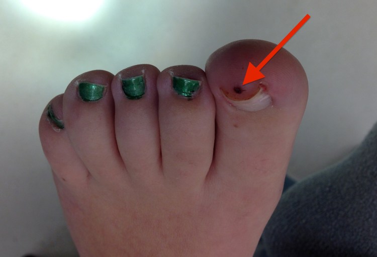 melanoma on toe