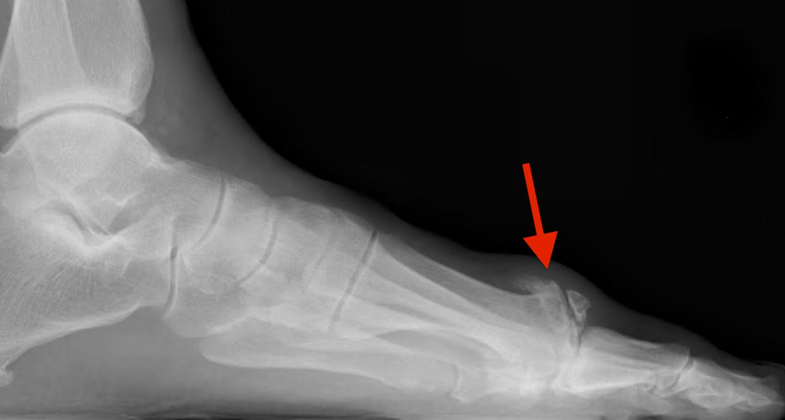 hallux limitus
