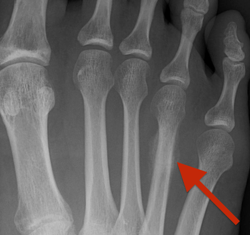 stress fracture of metatarsal