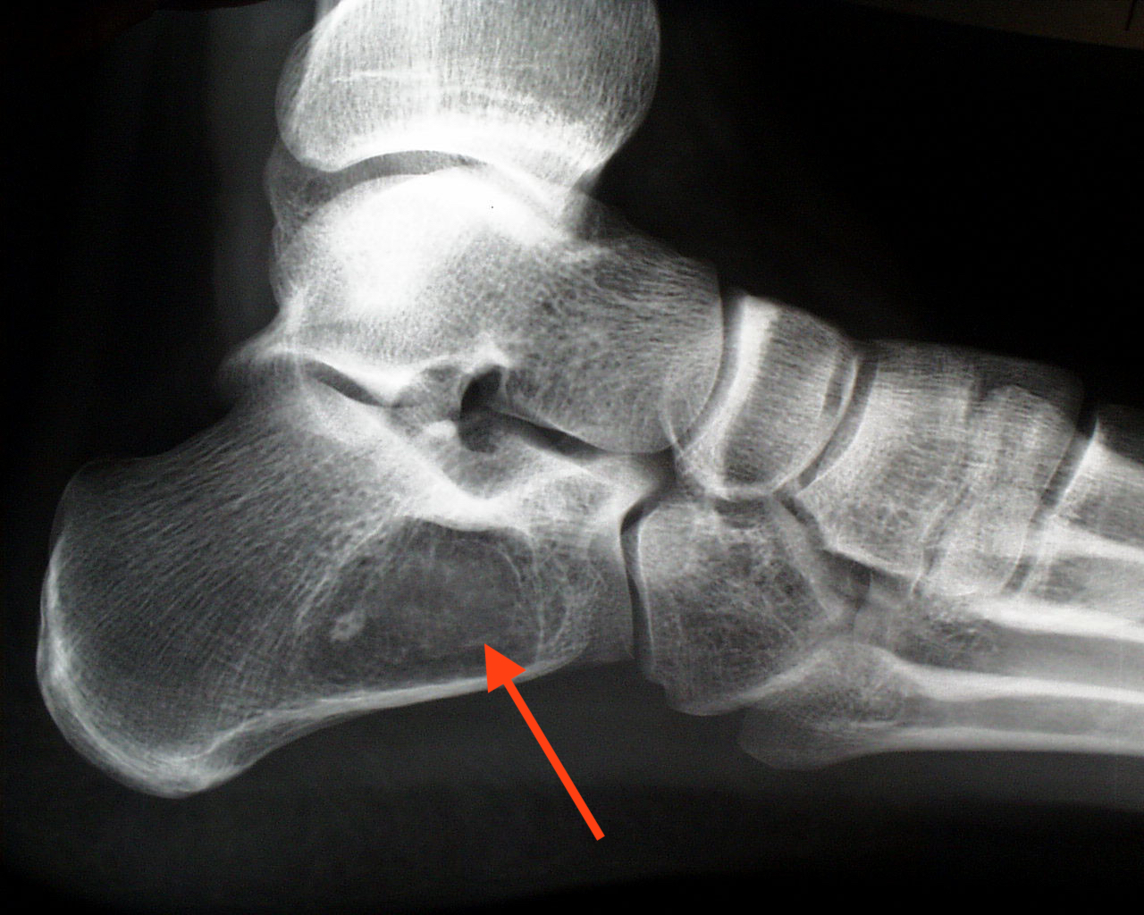 bone tumor foot