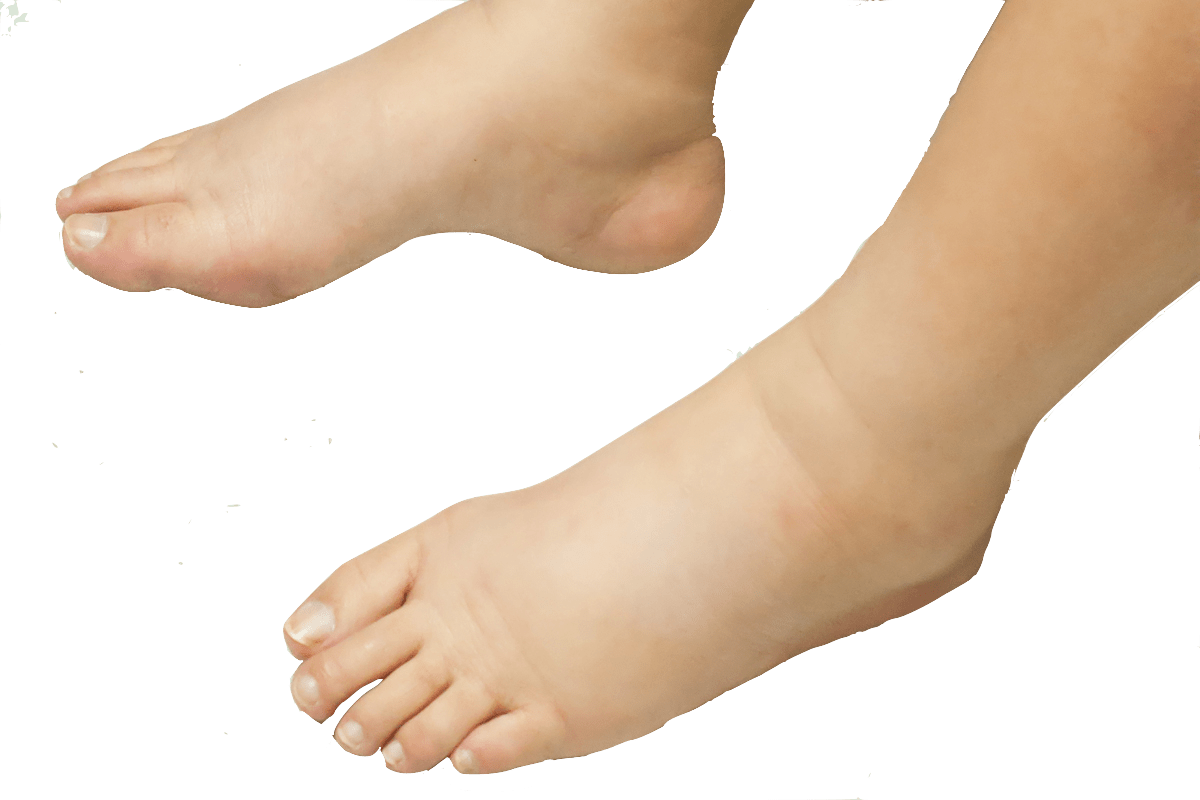 foot swelling in kids