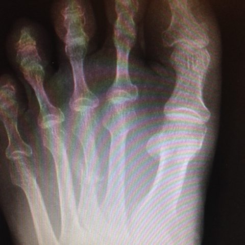 metatarsal fracture
