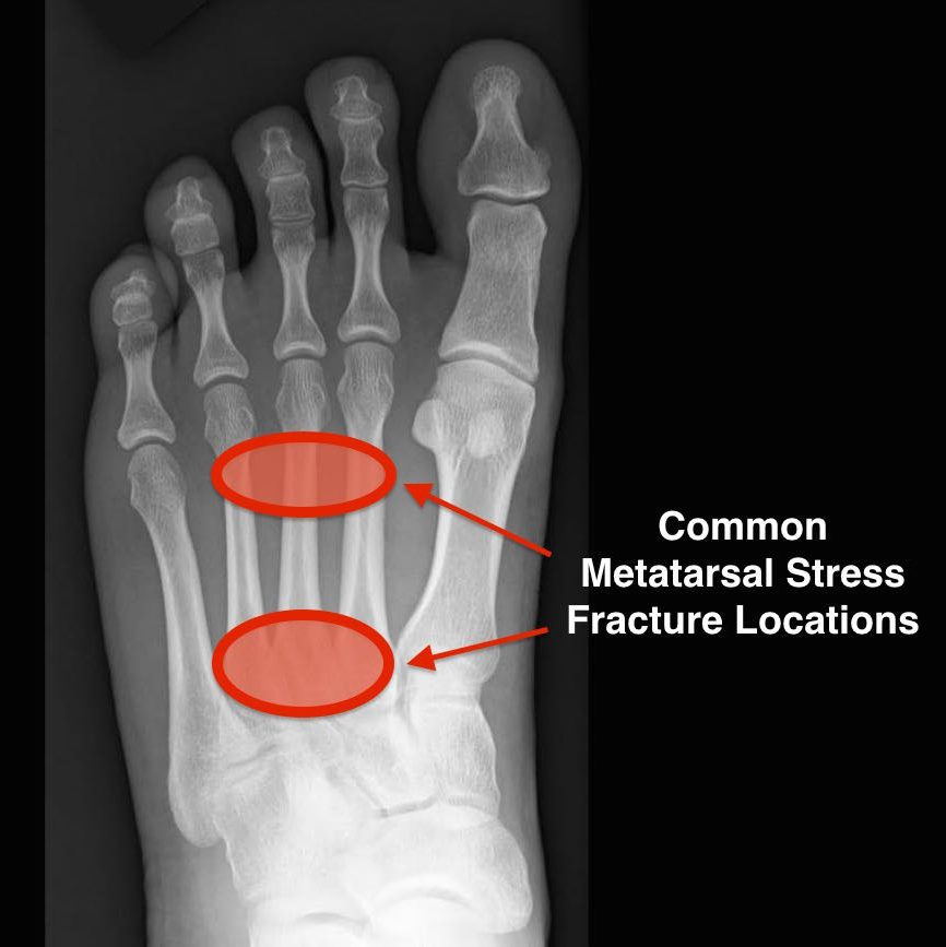metatarsal stress fracture