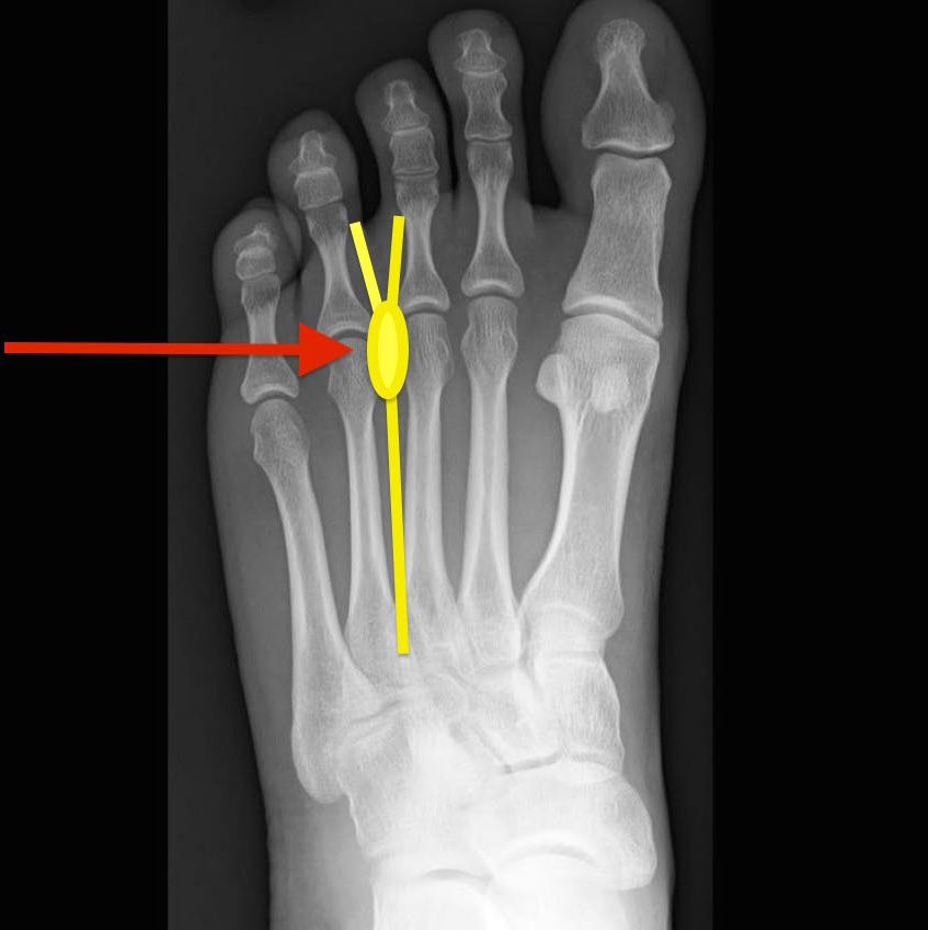 neuroma