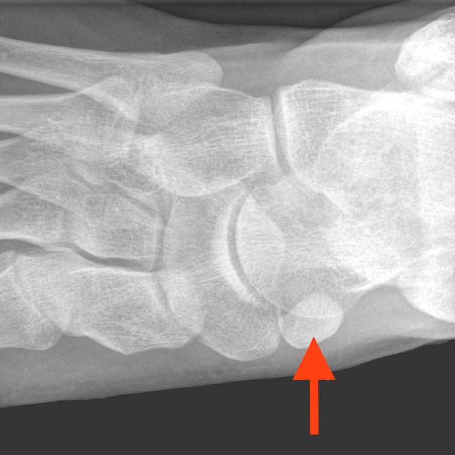 accessory bone foot