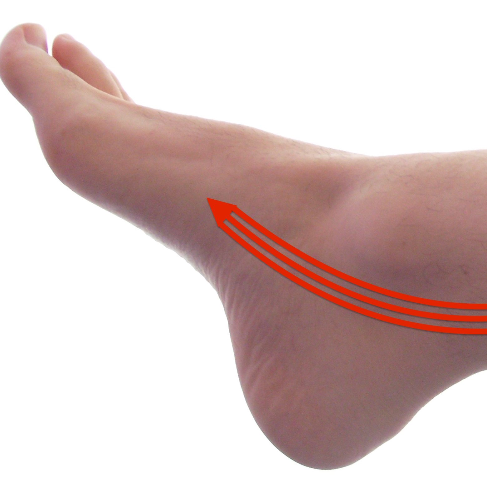 posterior tibial tendonitis