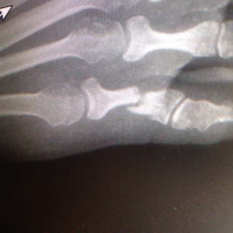 toe fracture