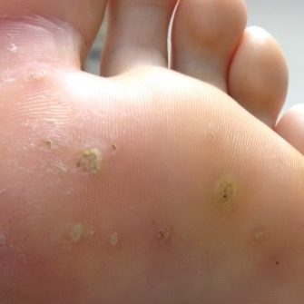 foot warts
